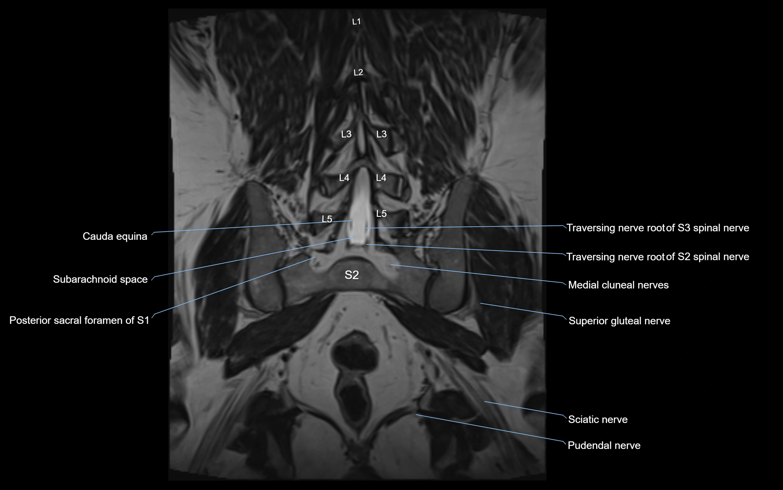 MR lumbosacral plexus cross sectional anatomy 3T  radiology  image-img-09001-00053.webp
